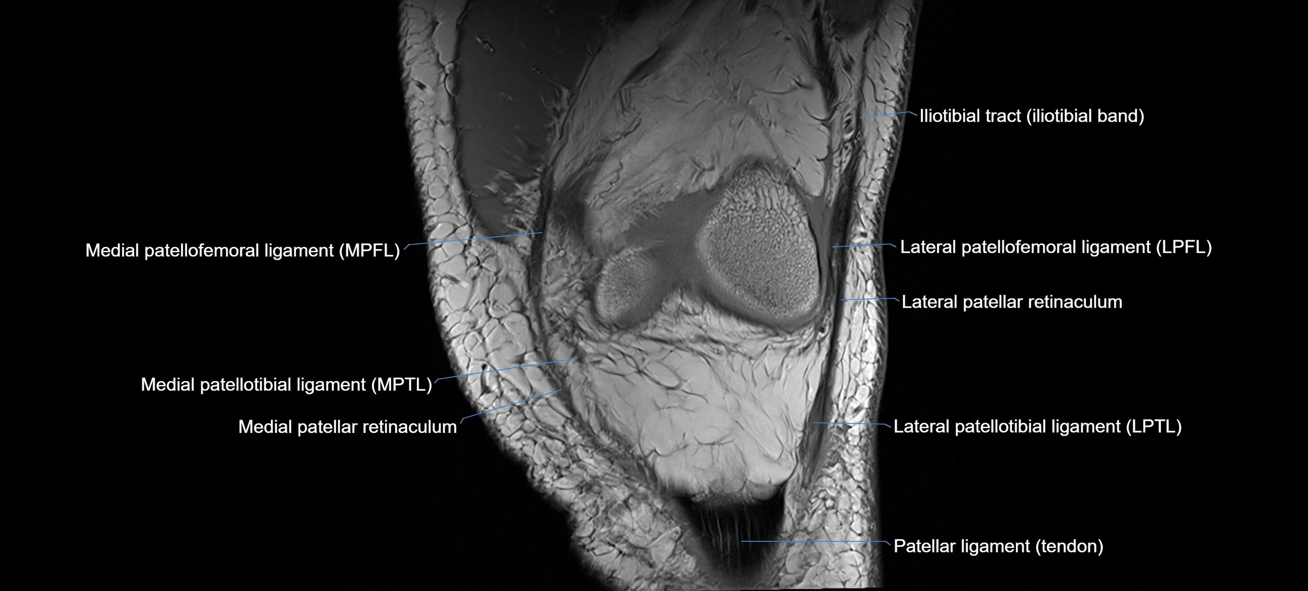 MRI coronal  ligaments cross sectional anatomy 3T  radiology  image-img-04001-00010.webp